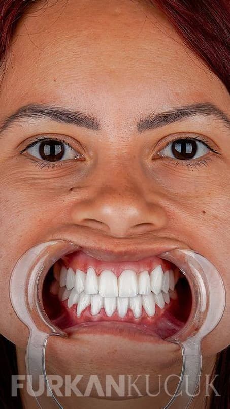 Dientes blancos y alineados de la misma mujer después del tratamiento dental estético