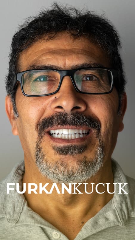 Same man smiling with a complete restored smile after treatment