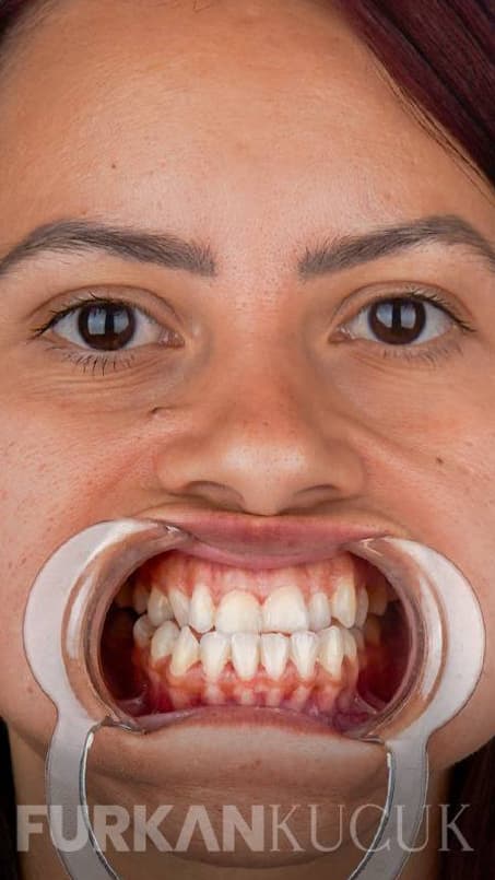Woman's teeth with a cheek retractor before cosmetic dental treatment