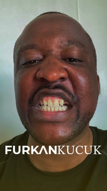 Man showing damaged and missing front teeth before dental treatment