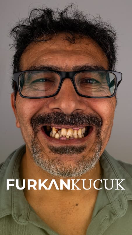 Man showing discolored and missing teeth before full-smile treatment